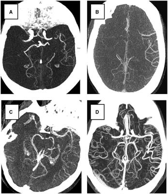 Siamese model for collateral score prediction from computed tomography angiography images in acute ischemic stroke